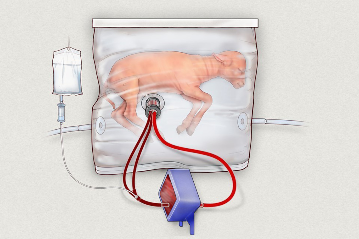 artificial womb preemies lamb